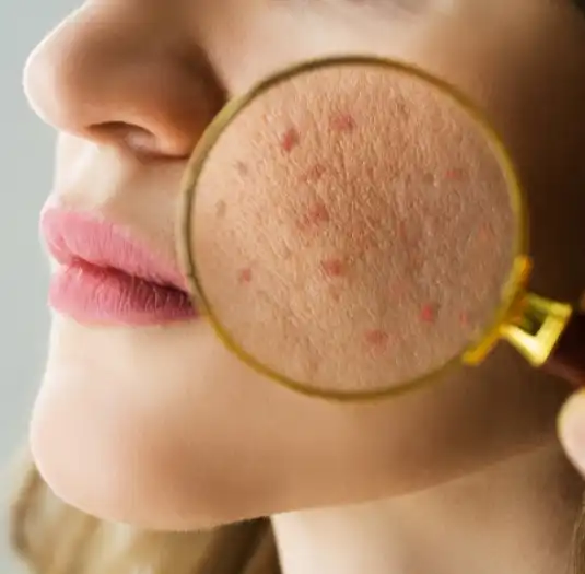 Skin Microbiome